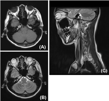 A 28 Year Old Woman Who Wore Circle Contact Lenses Mri Showed A Susceptibility Artifacts