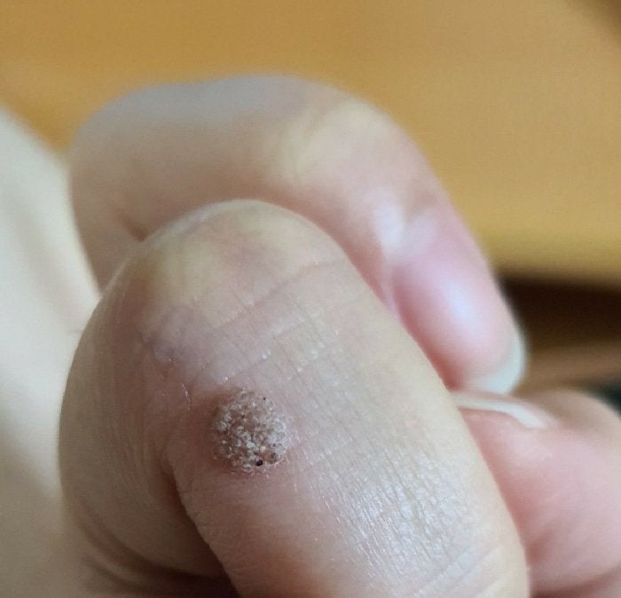 病毒疣 手指 warts on finger hand