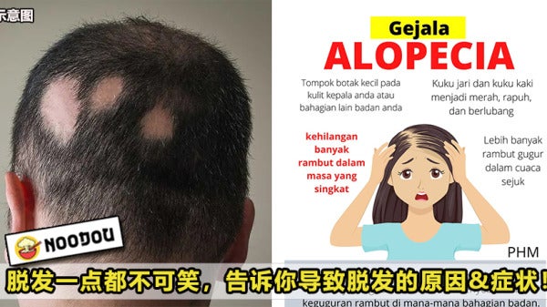 Alopecia Featured