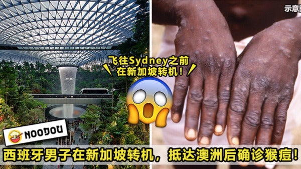 Monkeypox Singapore Feature Image