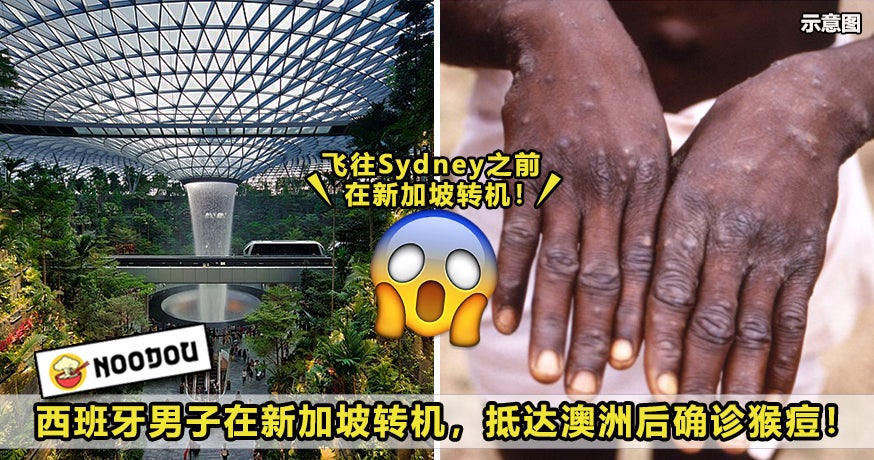 Monkeypox Singapore Feature Image