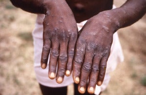 monkeypox hand
