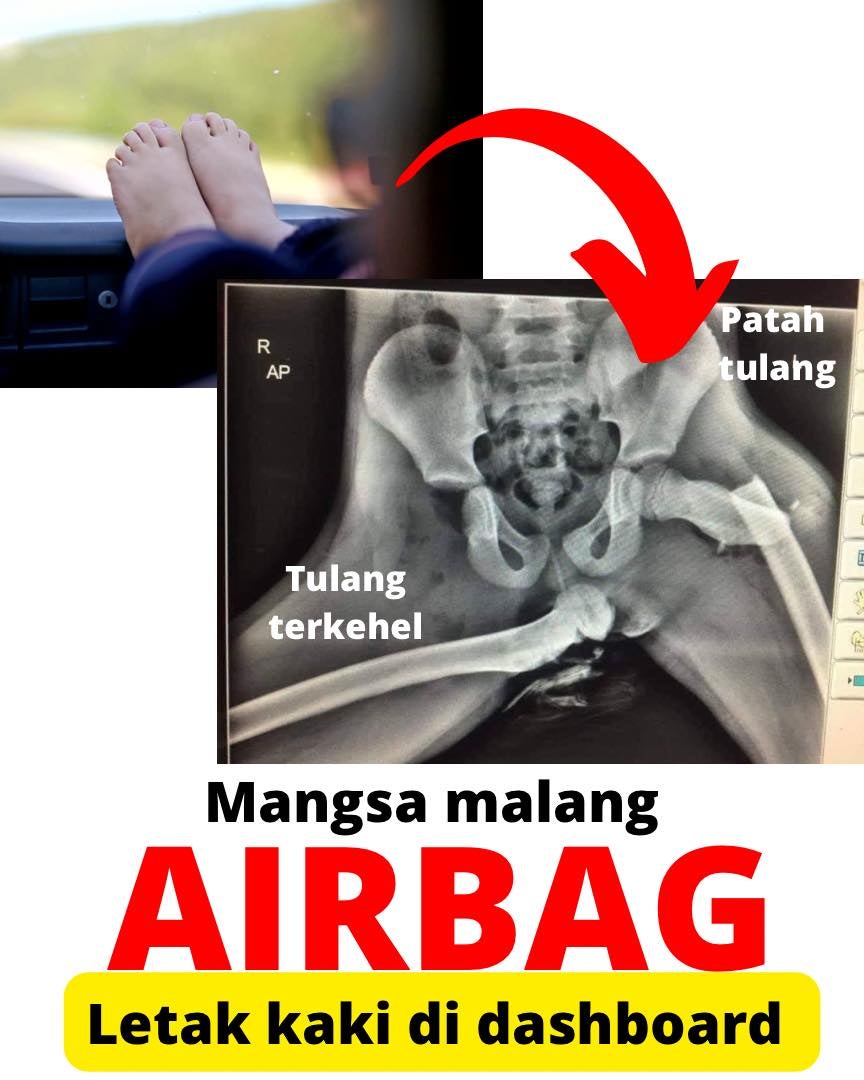 airbag