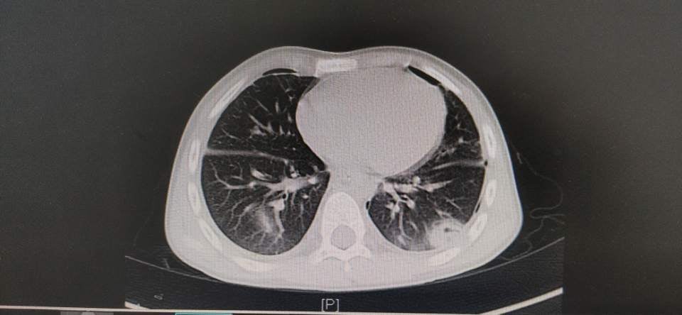 肺吸虫感染肺部CT