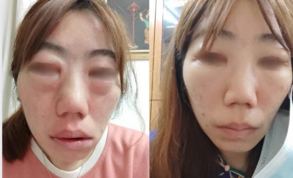 woman face swollen allergy reaction medicine 2