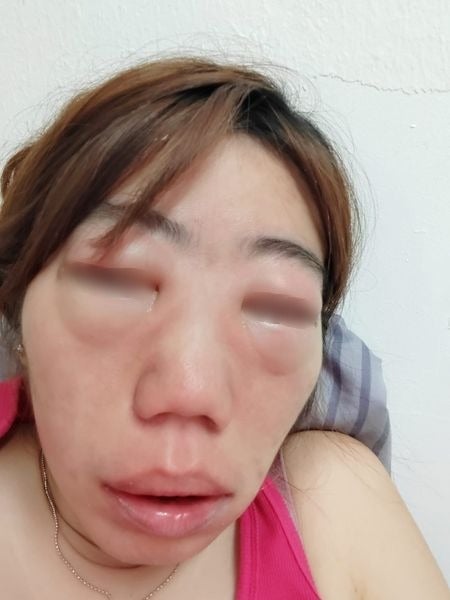 woman face swollen allergy reaction medicine