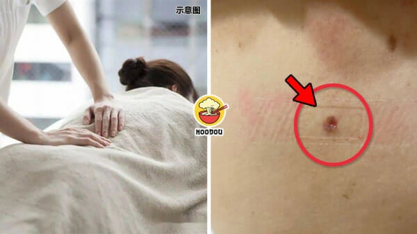 Massage Half Mole Ripped Off Feature Image