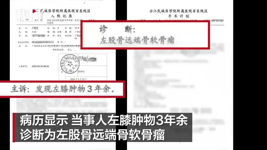 17岁少少年左膝长骨瘤医生切右膝 8