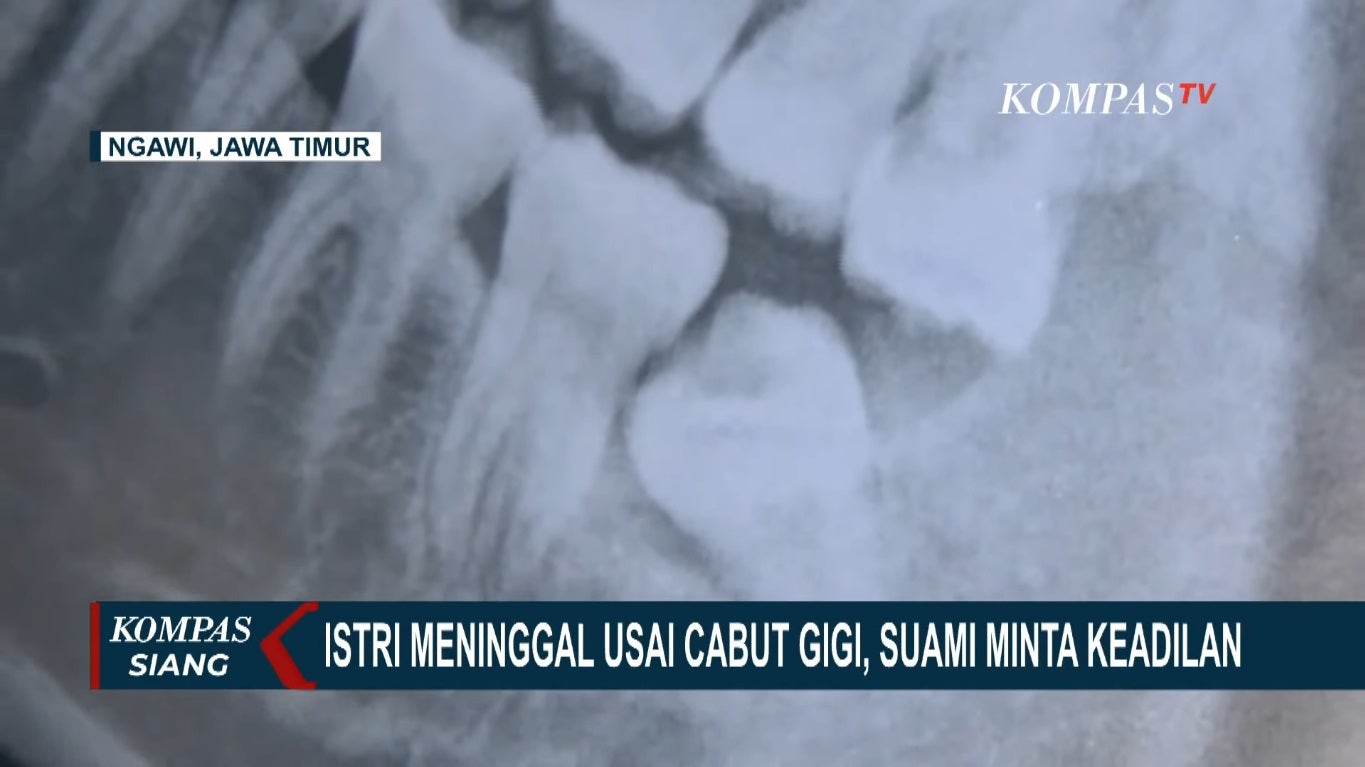 wisdom tooth xray wife extract died