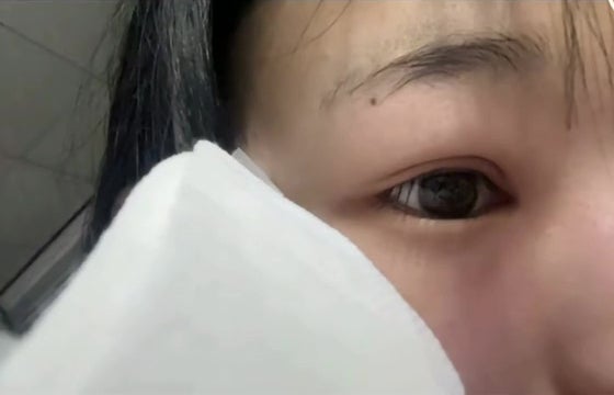 猫咪不小心抓伤主人眼皮变双眼皮 12