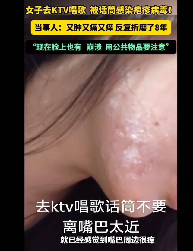 女子脸颊疱疹