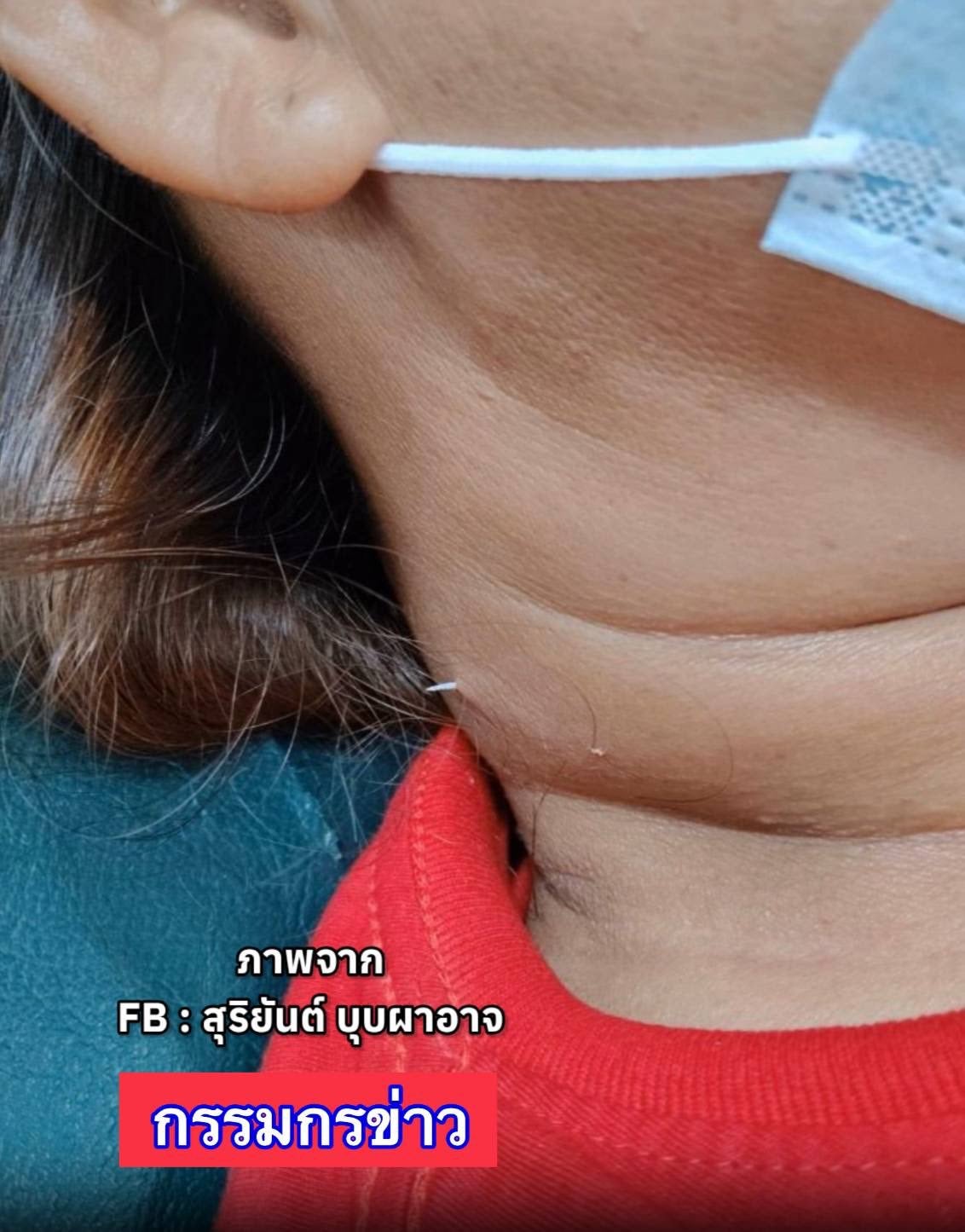 fish bone poke out of neck skin woman 2 weeks drink fish soup