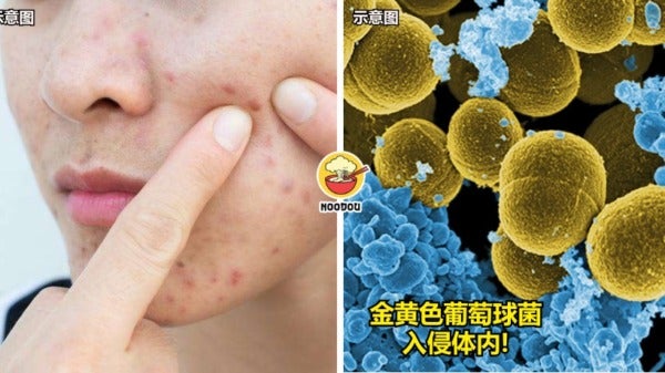 FT IMAGE pimple