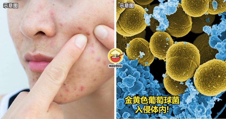 【别乱挤痘痘！】15岁少女挤脸上痘痘后引发感染，竟不幸去世！