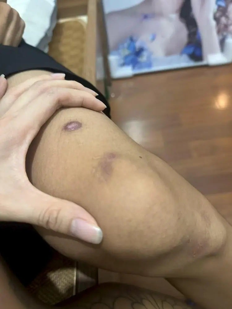 wound