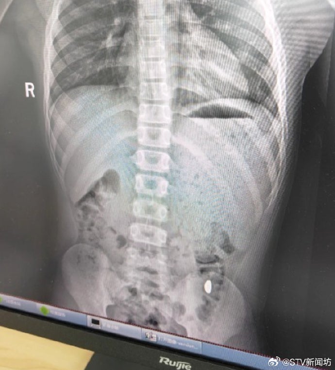 11岁儿子误吞妈妈10克金豆子2