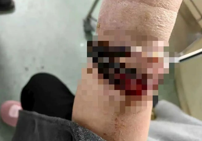 女子手镯串珠10年没脱长进肉里感染