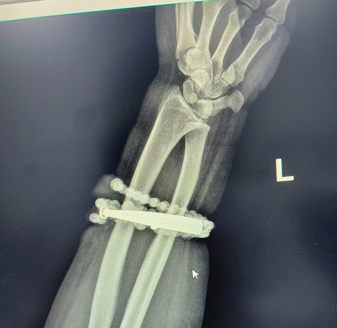 女子手镯串珠10年没脱长进肉里感染2