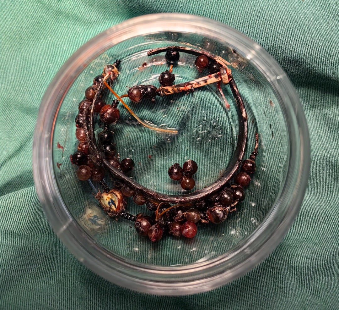 女子手镯串珠10年没脱长进肉里感染3