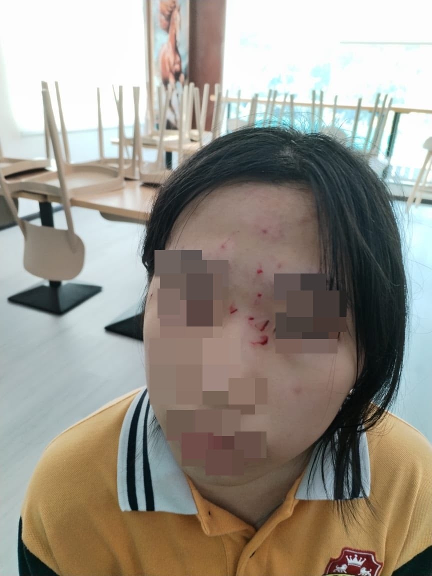 学校科学实验室爆炸事故眼睛受伤家长不满意校方解决方案 1