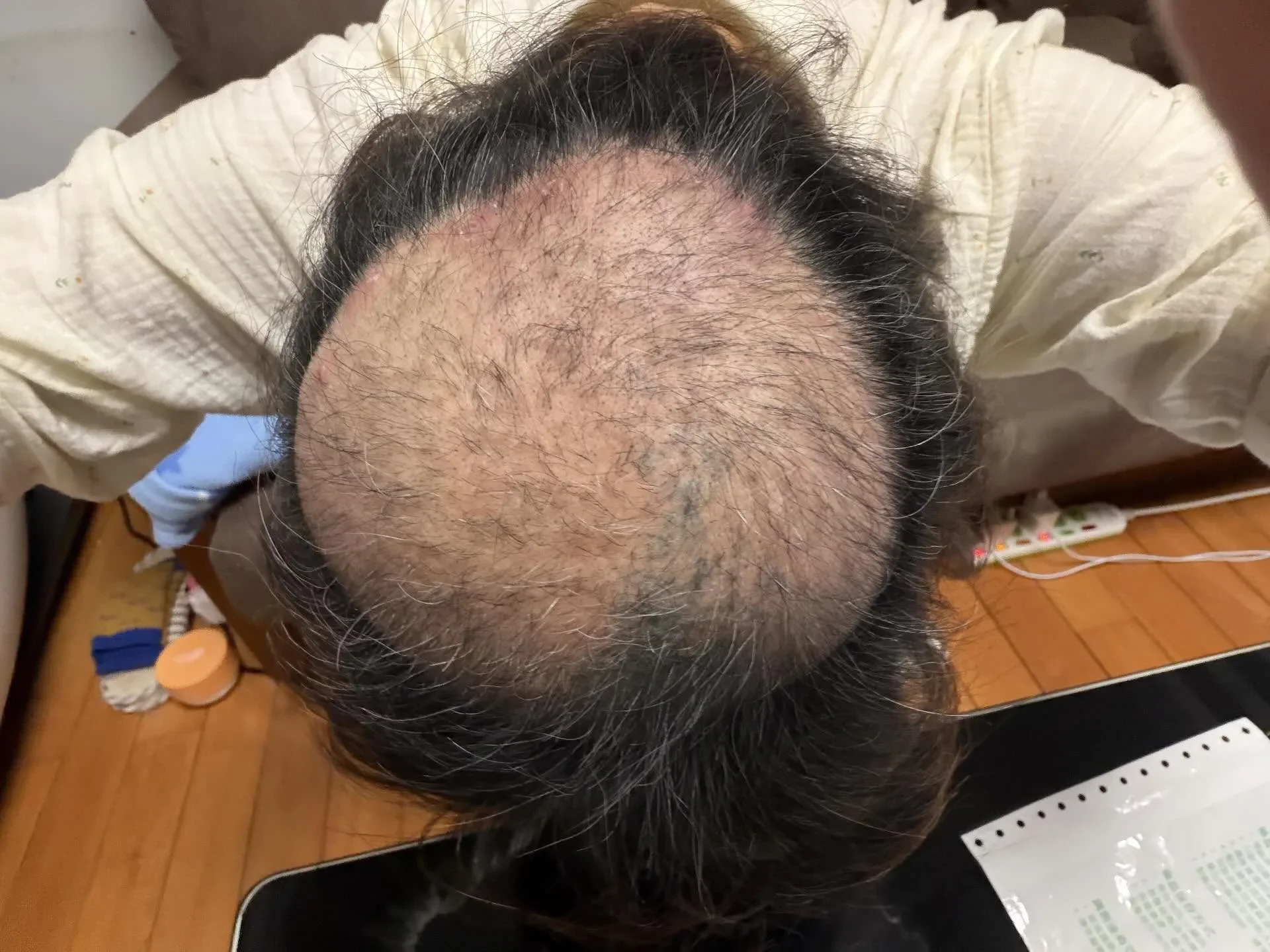 臭豆腐店太臭居民焦虑拔光头发 1