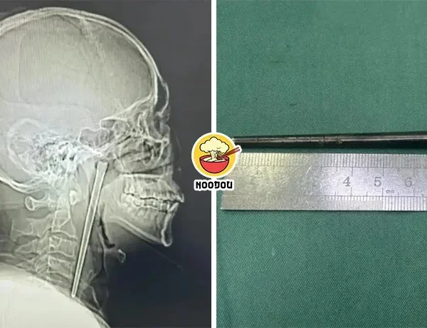 Chopstick Telan 8 Years Ft Img