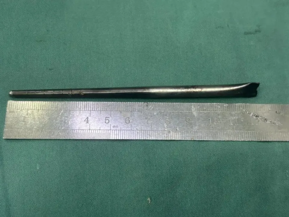 男子误吞筷子怕动手术8年后才取出X光 2